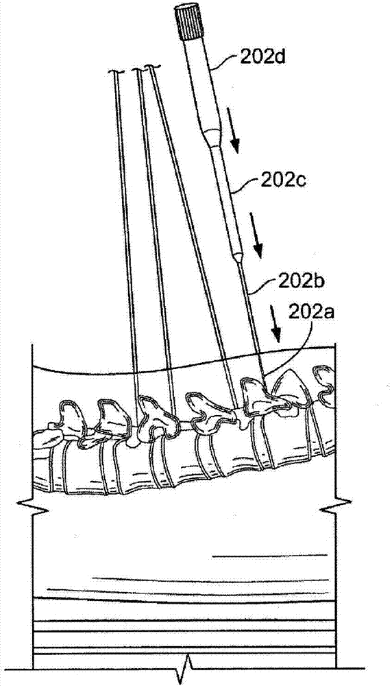 Systems and methods for performing minimally invasive surgery