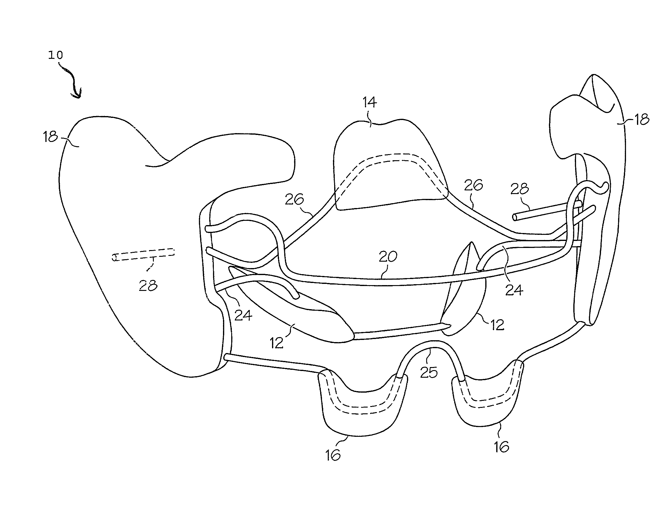 Intraoral apparatus for treating upper airway disorders