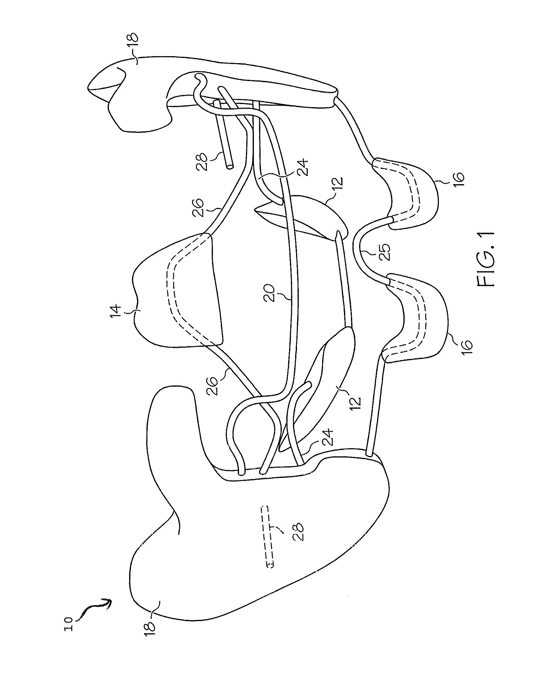 Intraoral apparatus for treating upper airway disorders