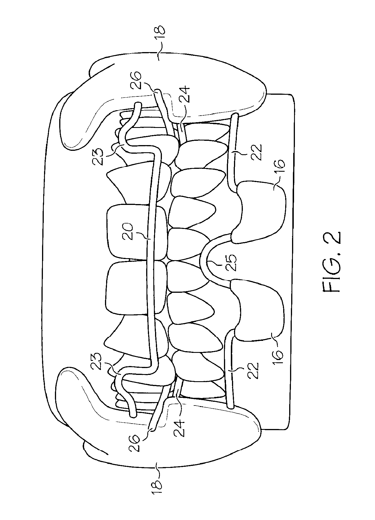 Intraoral apparatus for treating upper airway disorders