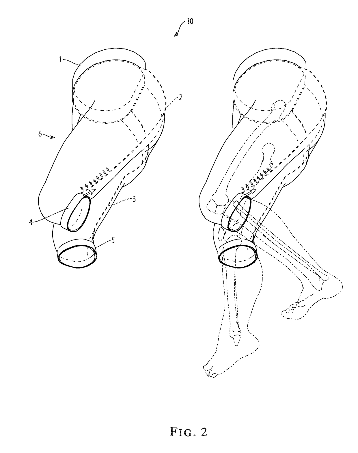 Knee-acl support breeches system and method