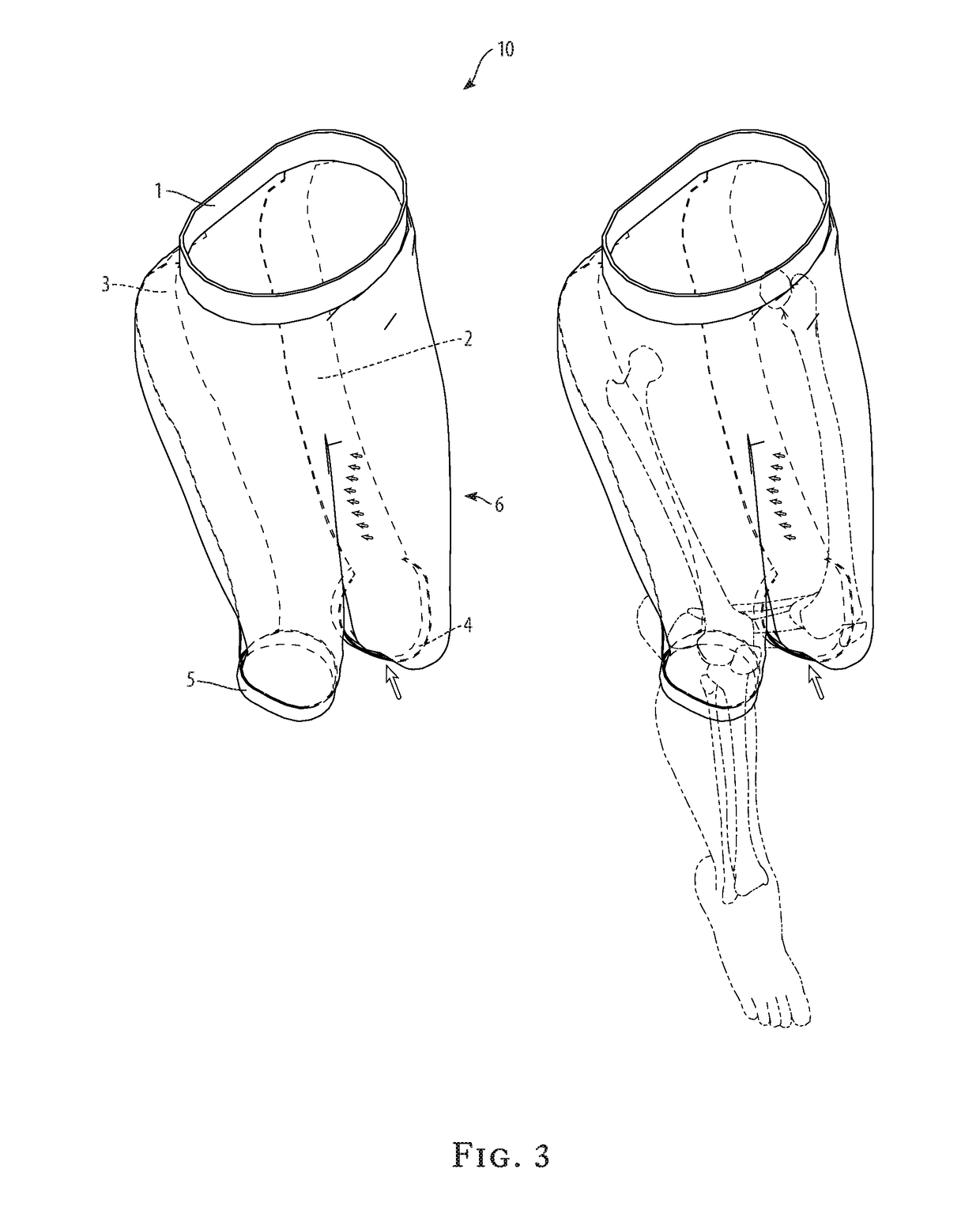 Knee-acl support breeches system and method