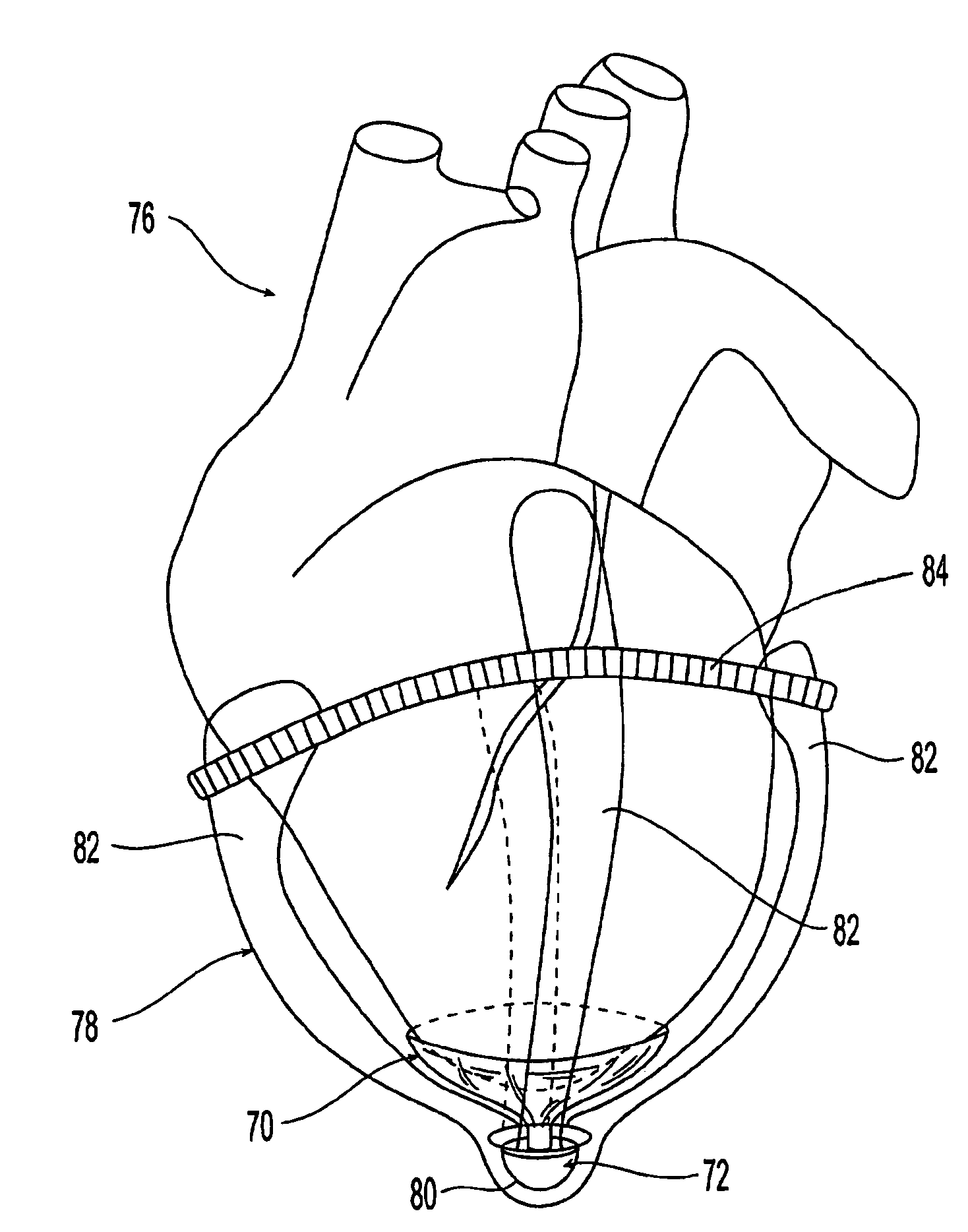 Modification of properties and geometry of heart tissue to influence function