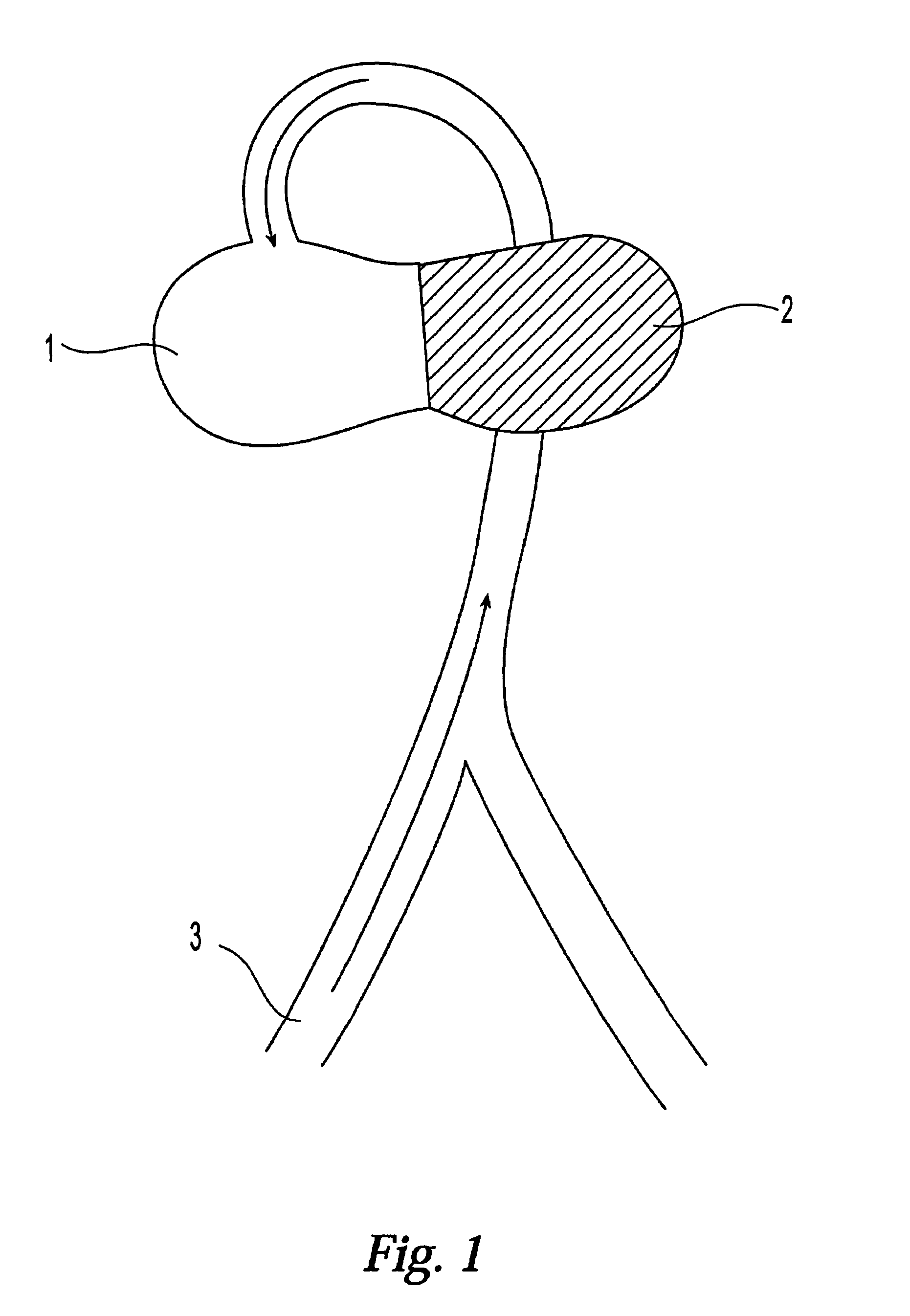 Modification of properties and geometry of heart tissue to influence function