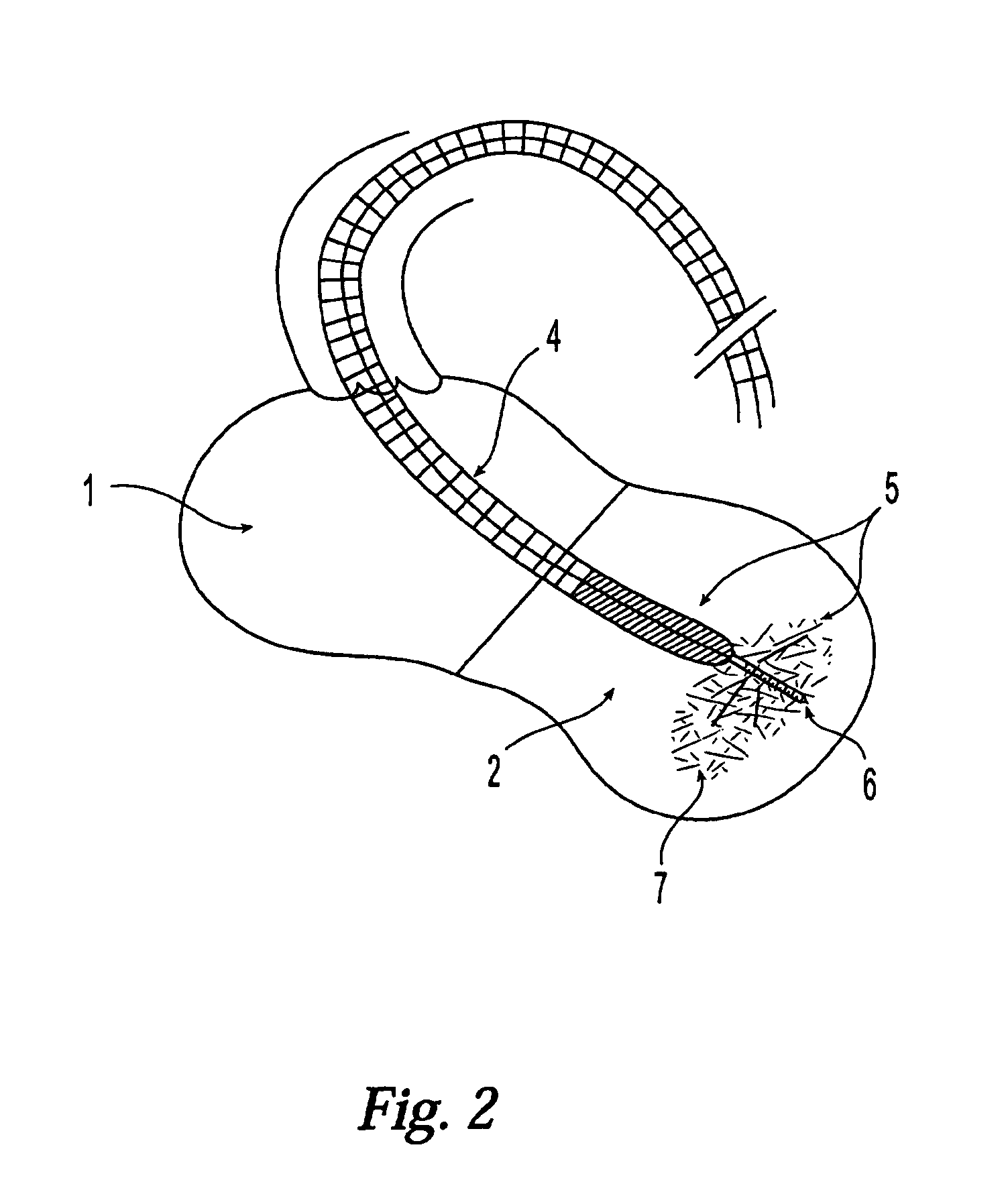 Modification of properties and geometry of heart tissue to influence function