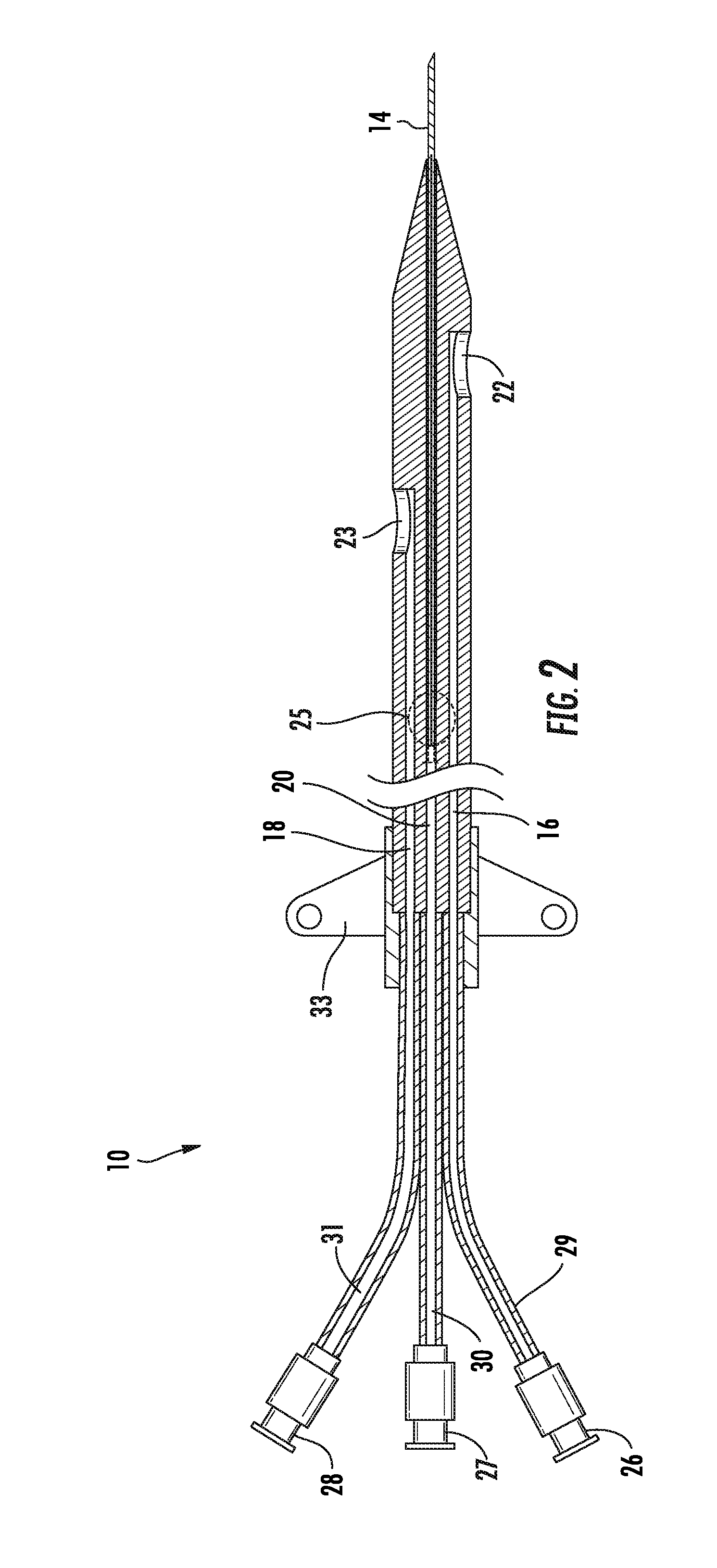 Rapid Insertion Integrated Catheter and Method of Using an Integrated Catheter