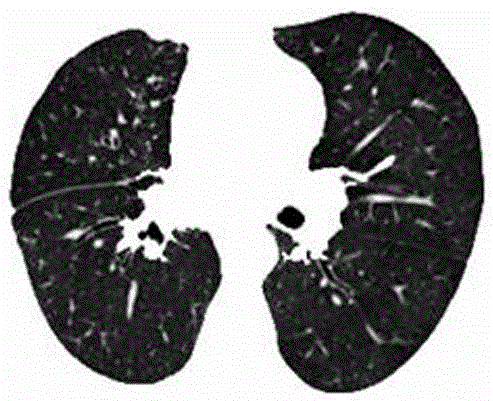 A Realization Method of Adaptive Hierarchical Big Data Display of Chest