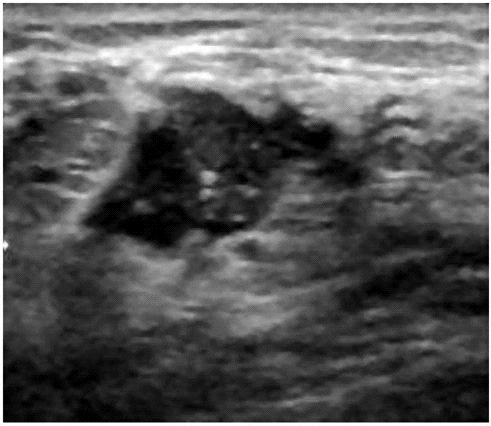 Breast tumor classification method and device based on ultrasound image feature correlation