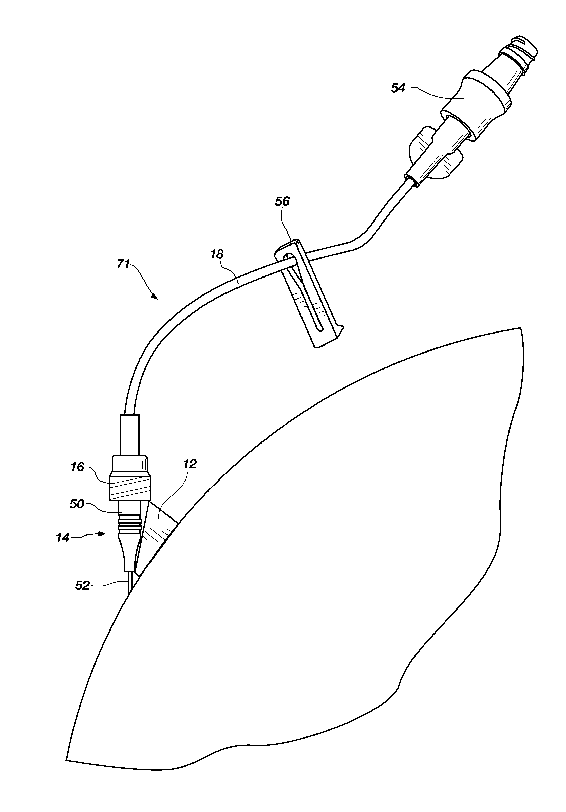 Catheter stress reliever and stabilizer