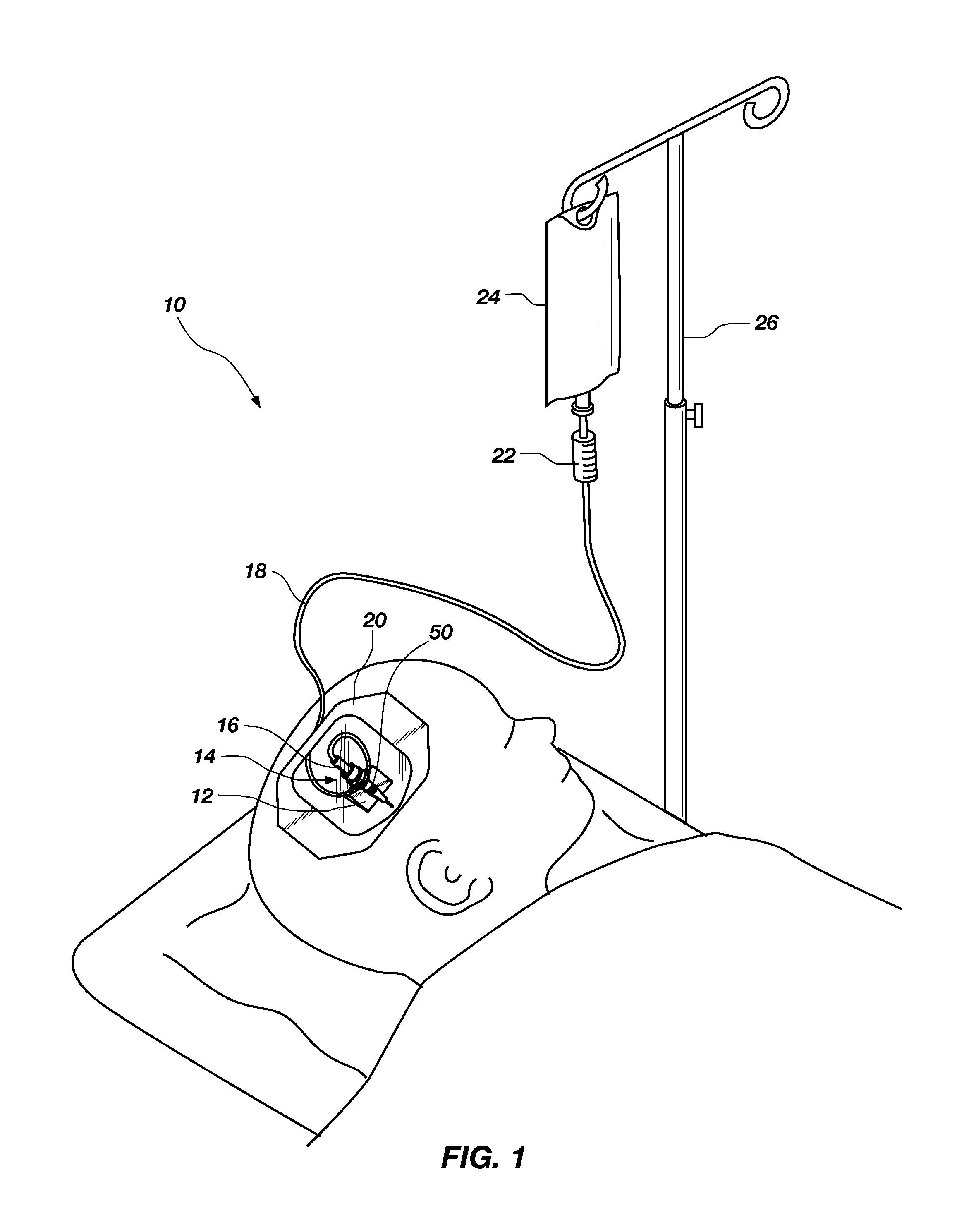 Catheter stress reliever and stabilizer