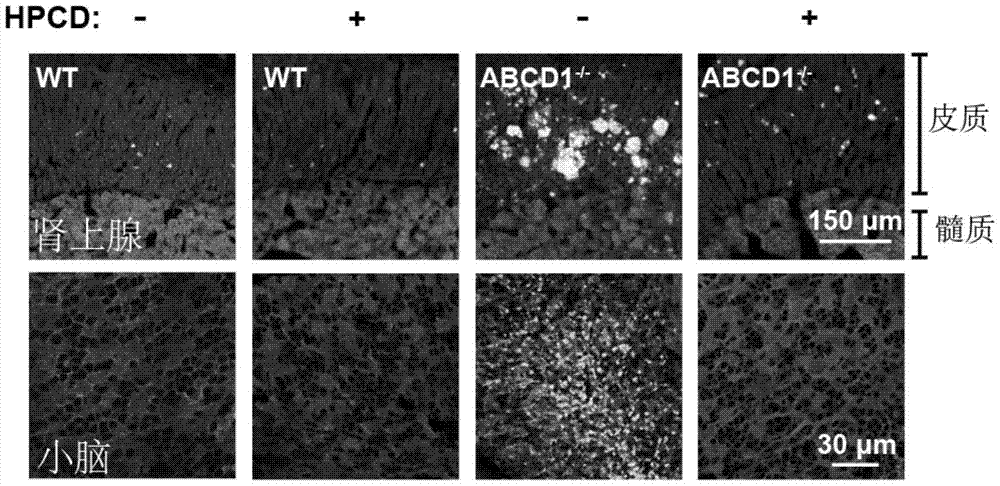 Application of 2-hydroxypropyl-β-cyclodextrin in preparation of medicine for treating X-linked adrenoleukodystrophy