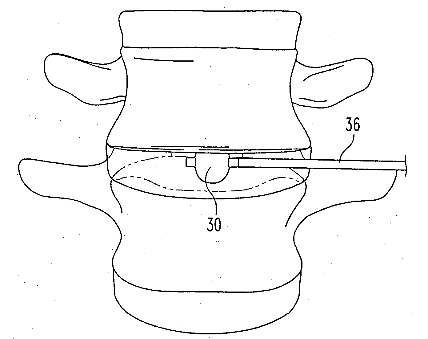 Methods for treating defects and injuries of an intervertebral disc