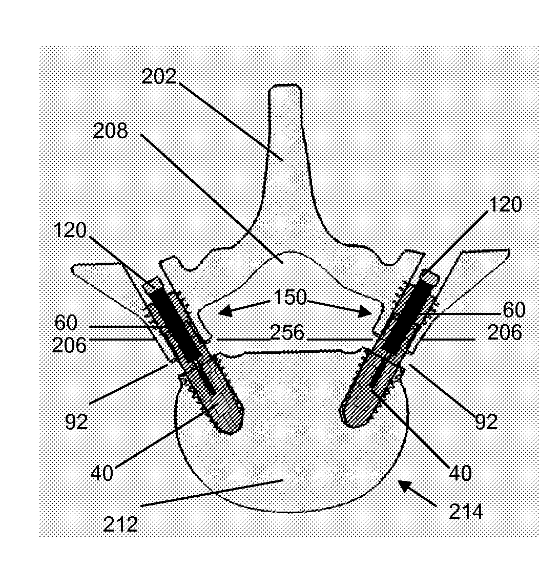 Method, Implant & Instruments for Percutaneous Expansion of the Spinal Canal