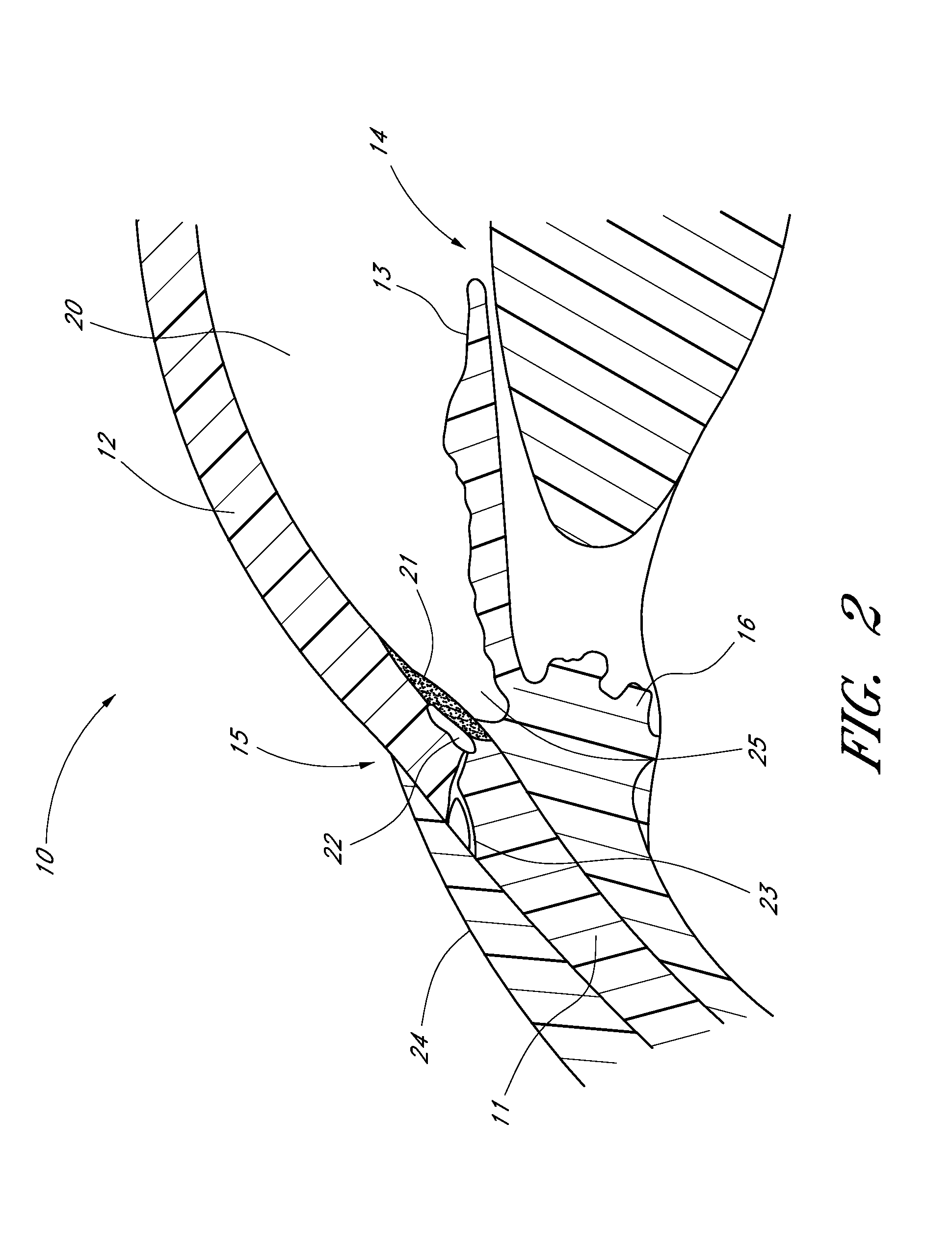 Method of monitoring intraocular pressure and treating an ocular disorder