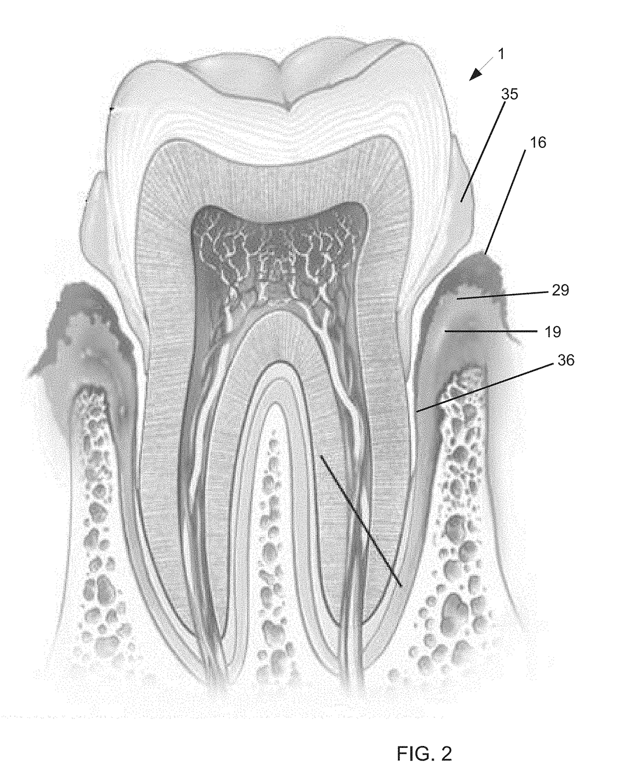 Periodontic treatment and method