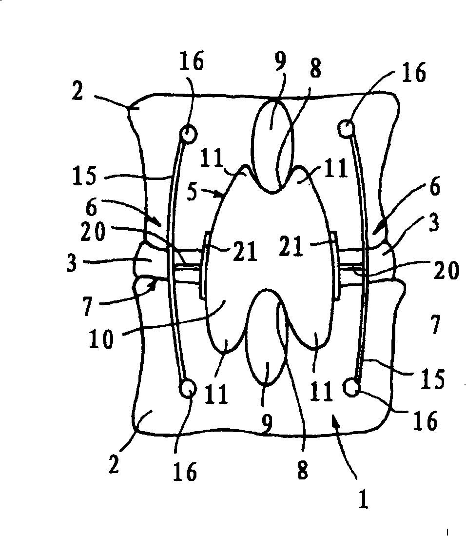 Posterior vertebral support assembly