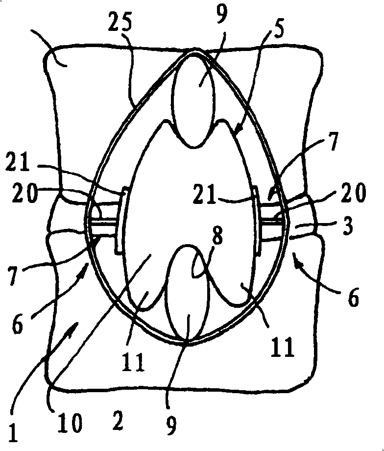 Posterior vertebral support assembly