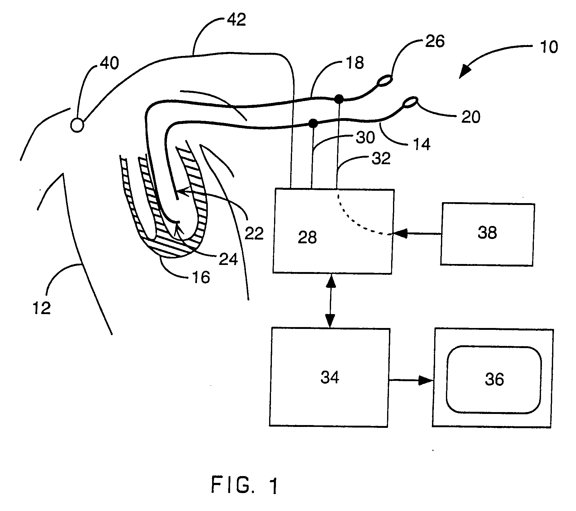 Electrophysiology Therapy Catheter