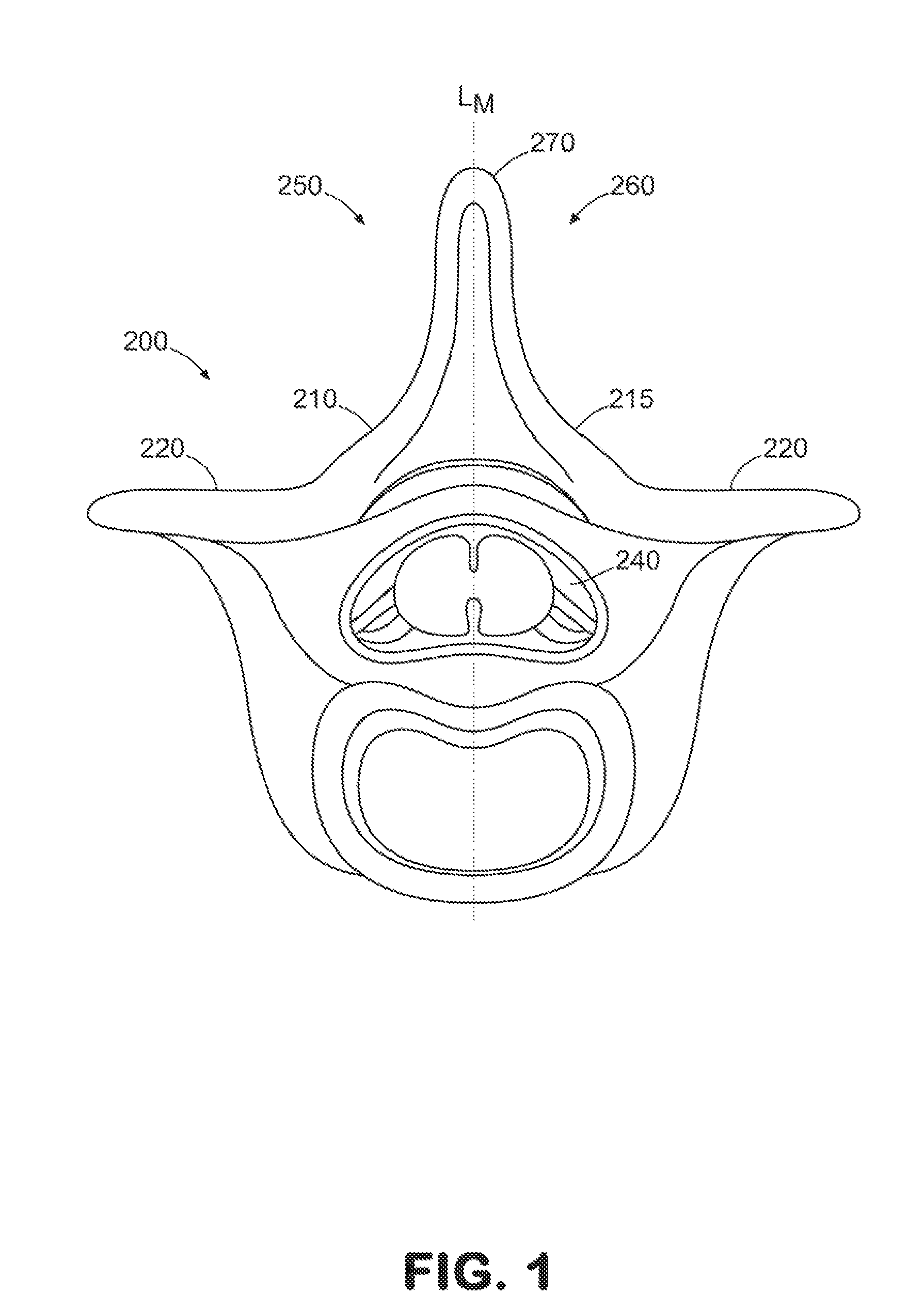 Laminoplasty system