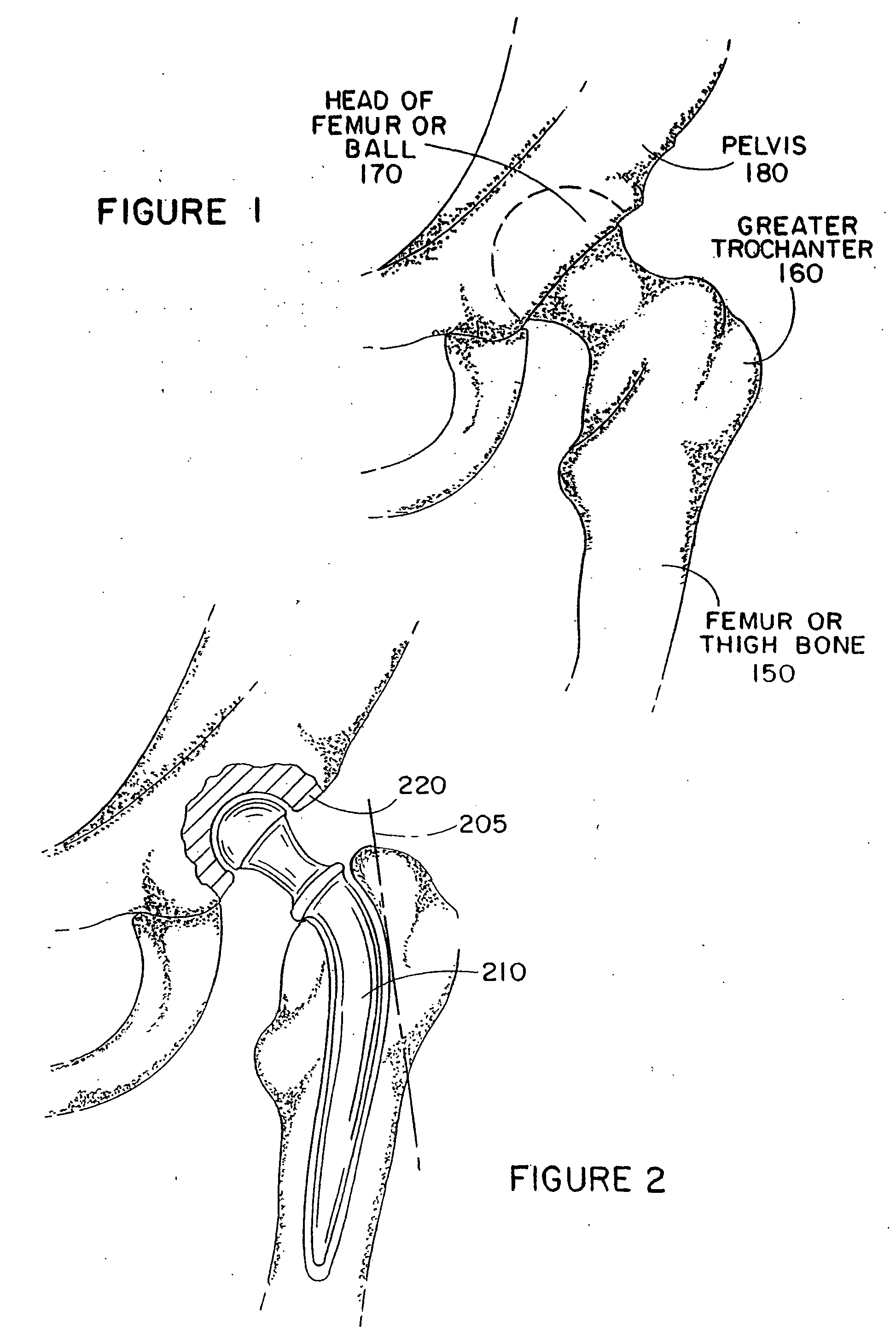 Apparatus and method for repairing the femur