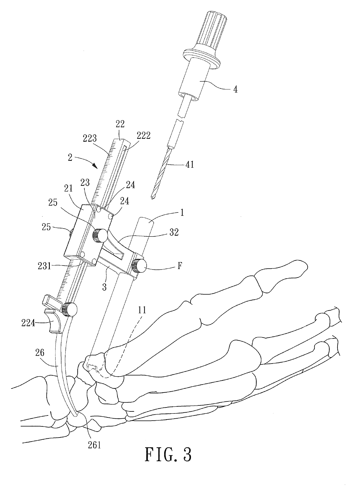 Minimally Invasive Bone Fracture Positioning Device