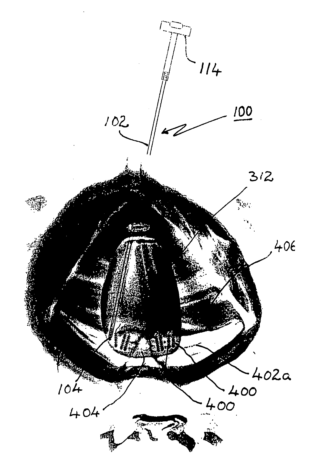 Apparatus and method for incision-free vaginal prolapse repair