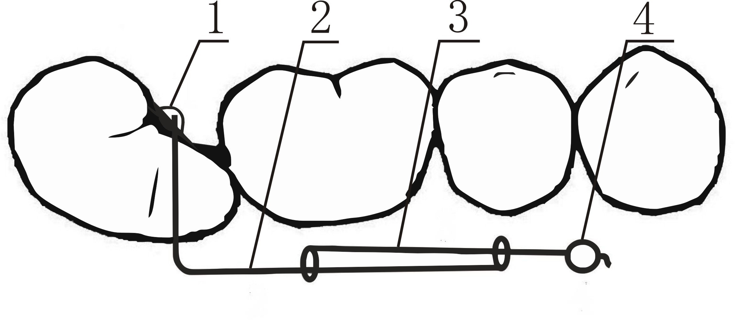 Implant type impacted molar correction device