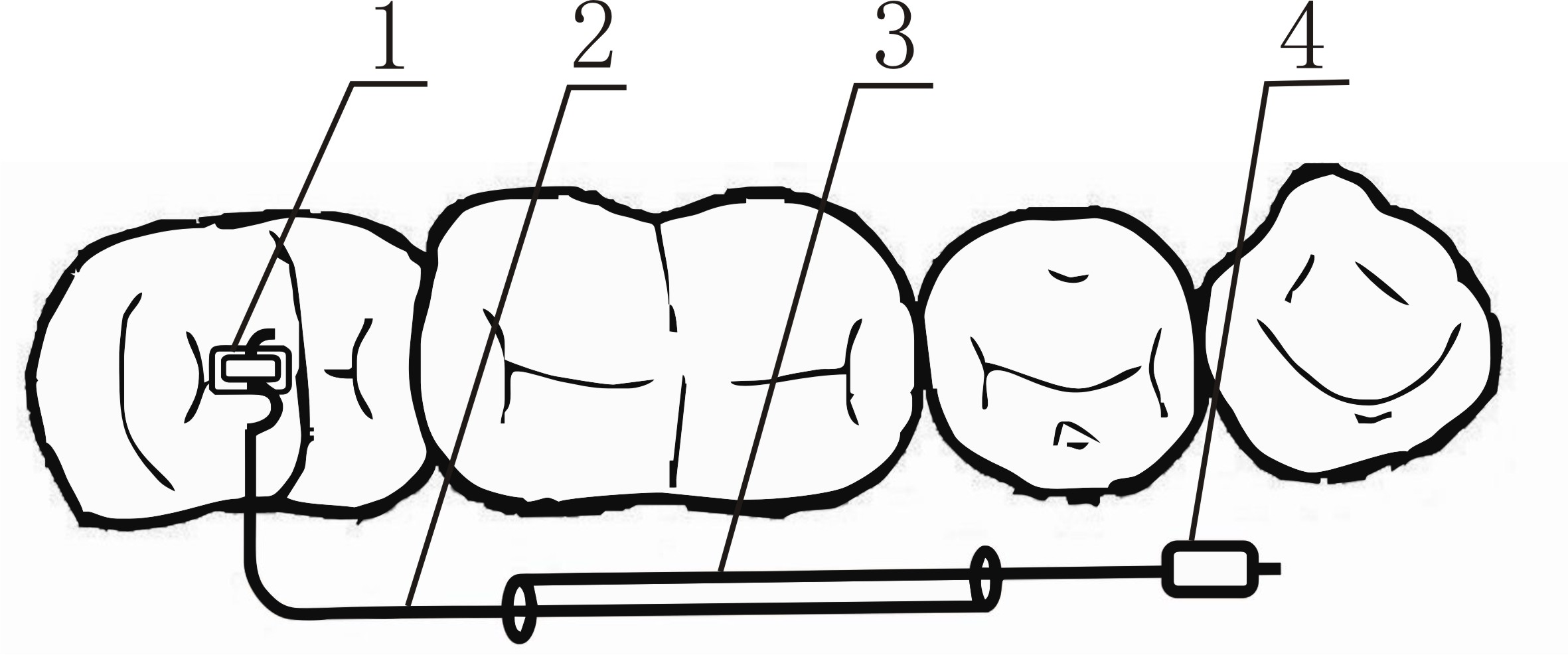 Implant type impacted molar correction device