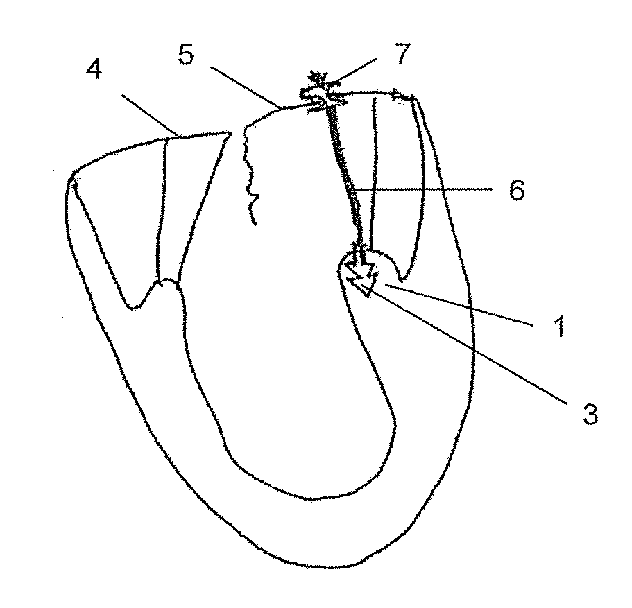 Medical apparatus and method for heart valve repair