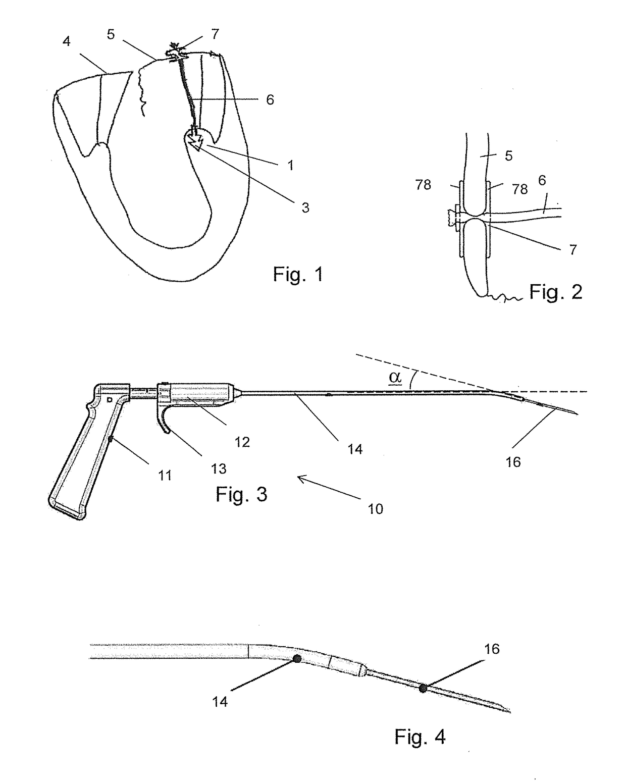 Medical apparatus and method for heart valve repair