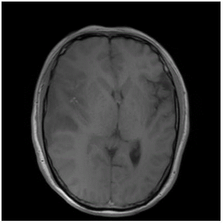 Method for extracting brain glioma region from brain nuclear magnetic resonance image