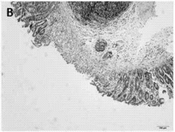 Composition for treating ulcerative colitis and preparation method and application thereof