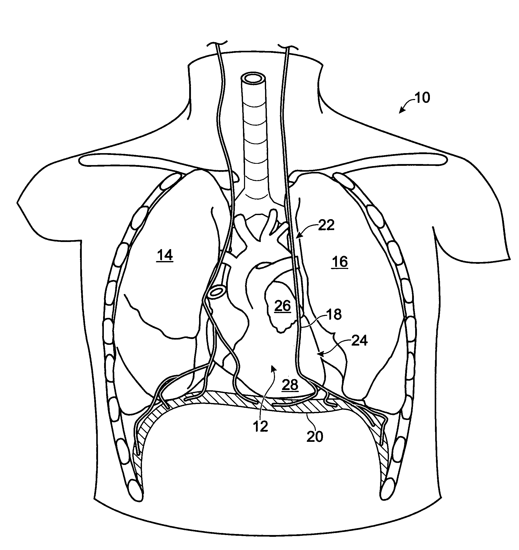 Mechanical, anatomical heart-pumping assist