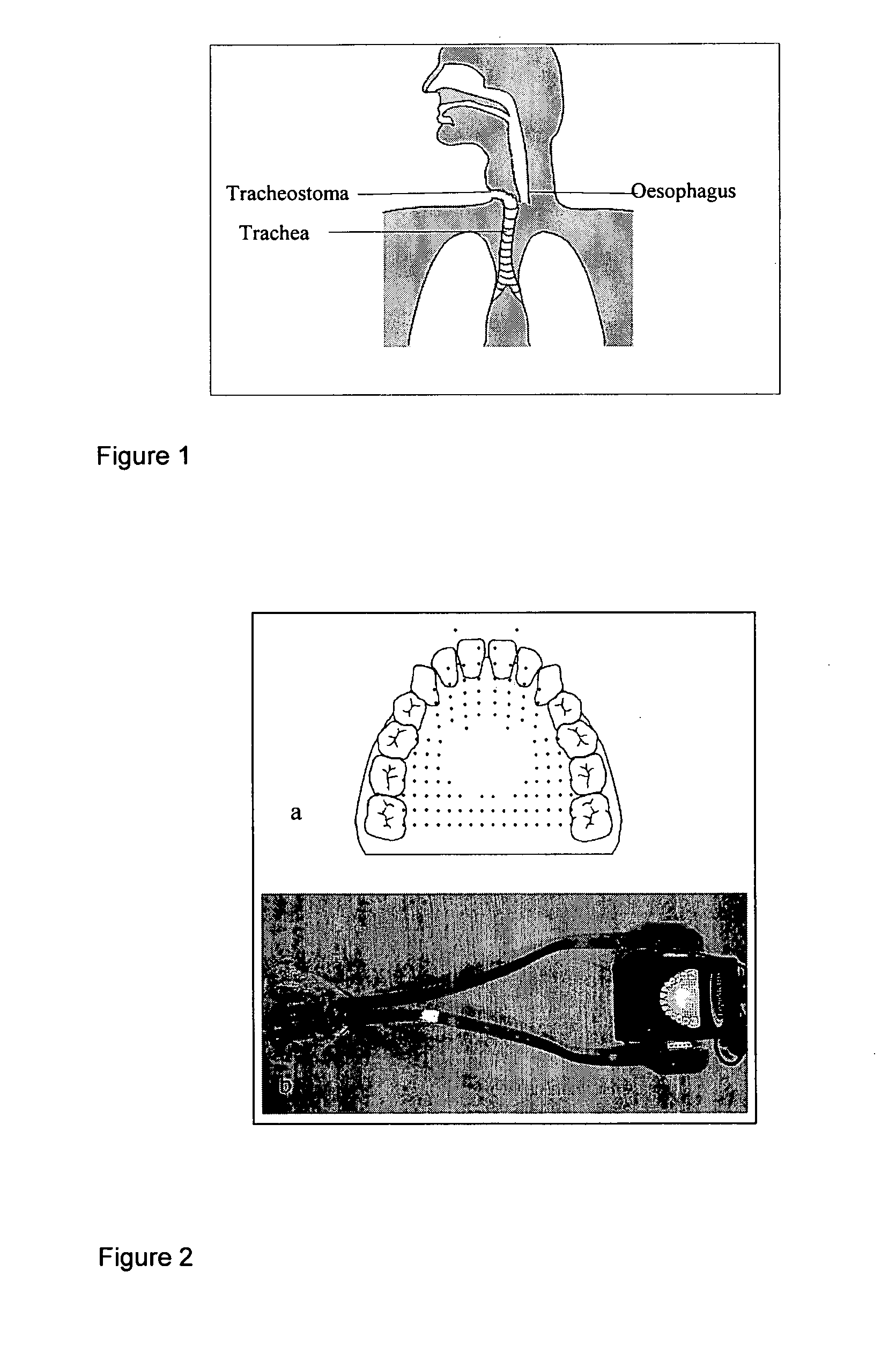 Artificial Larynx