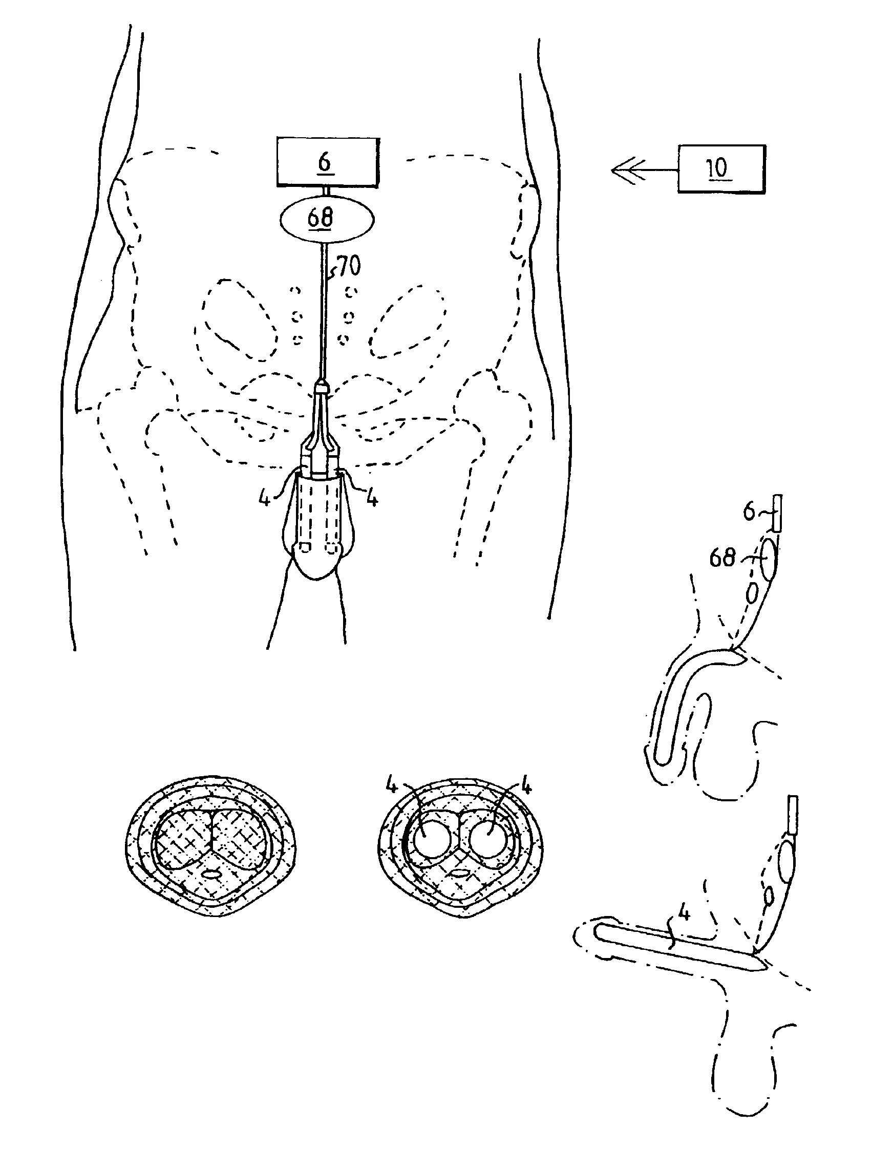 Male impotence prosthesis apparatus with wireless energy supply