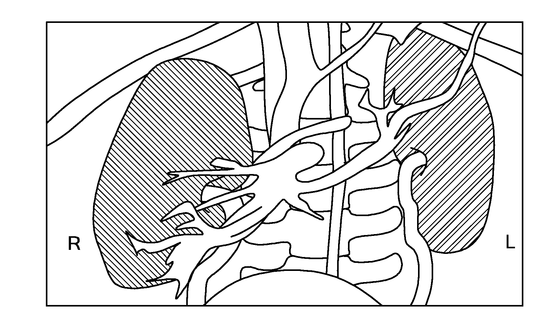 Propagating Shell for Segmenting Objects with Fuzzy Boundaries, Automatic Volume Determination and Tumor Detection Using Computer Tomography