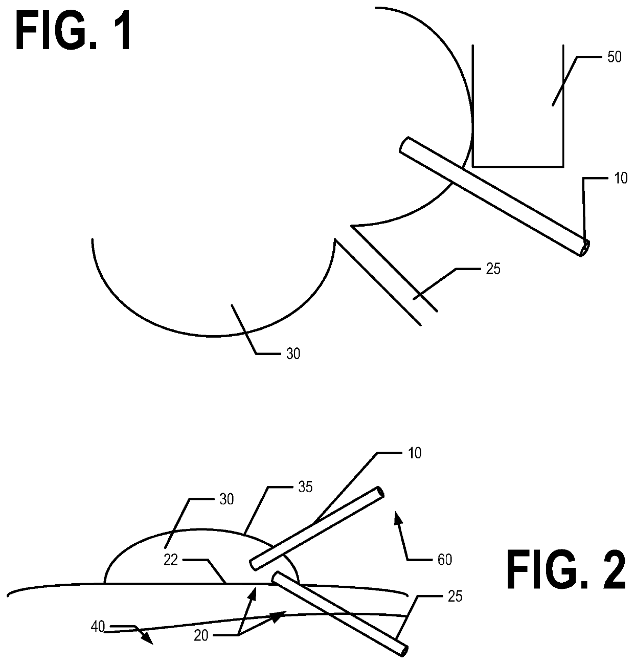 Enhanced drainage of failed glaucoma drainage device (GDD)