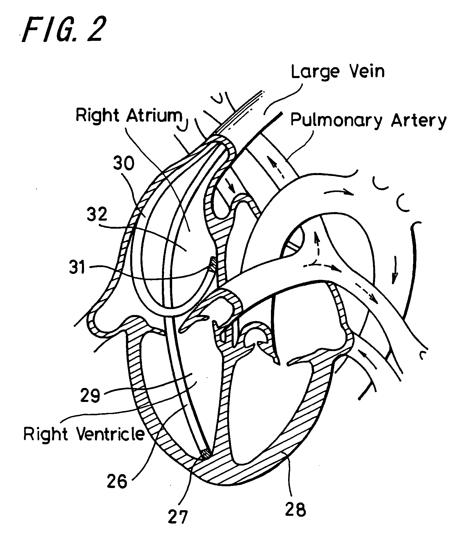 Heart treatment apparatus and heart treatment method