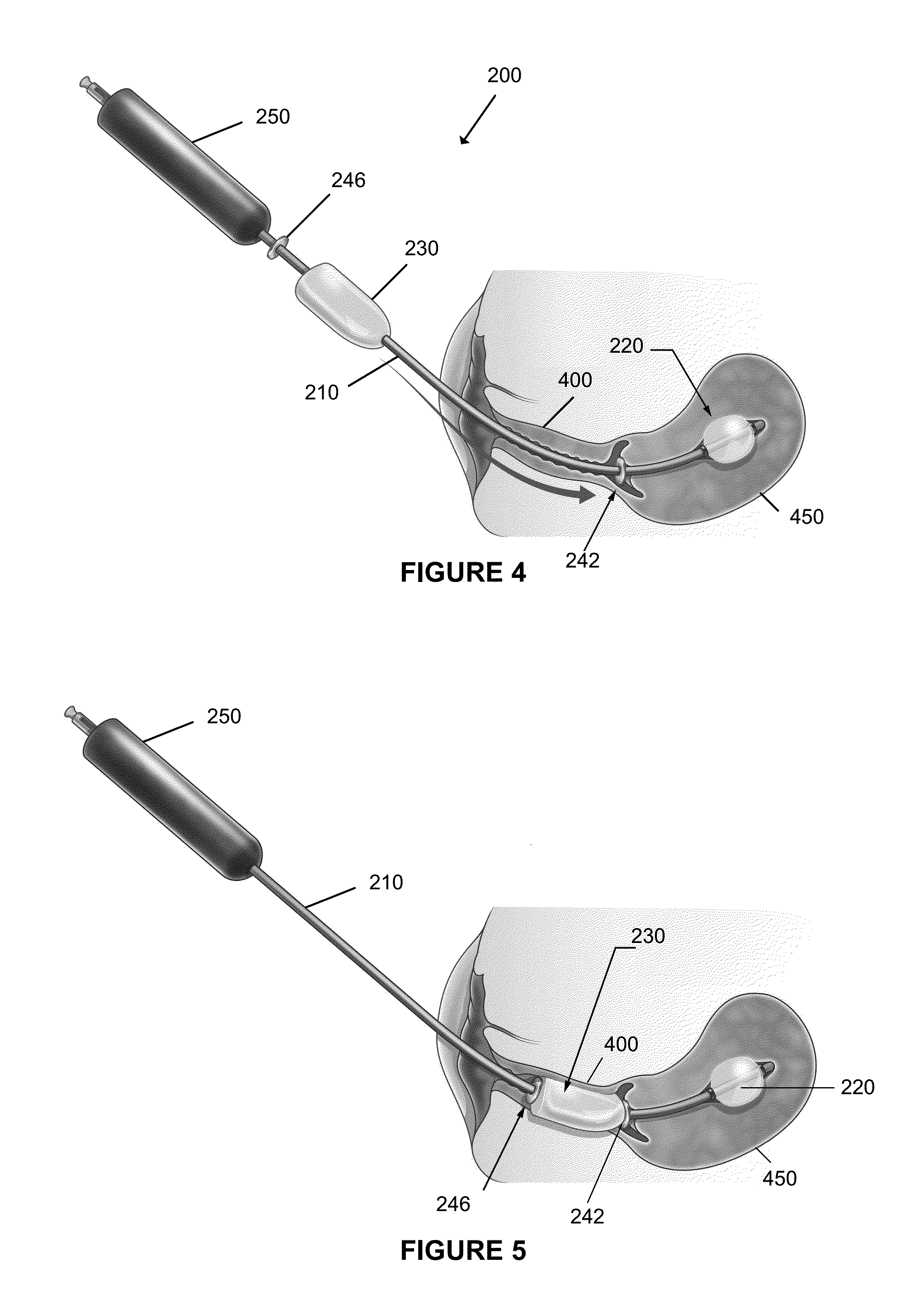 Surgical methods and devices for treatment of prolapsed uterus