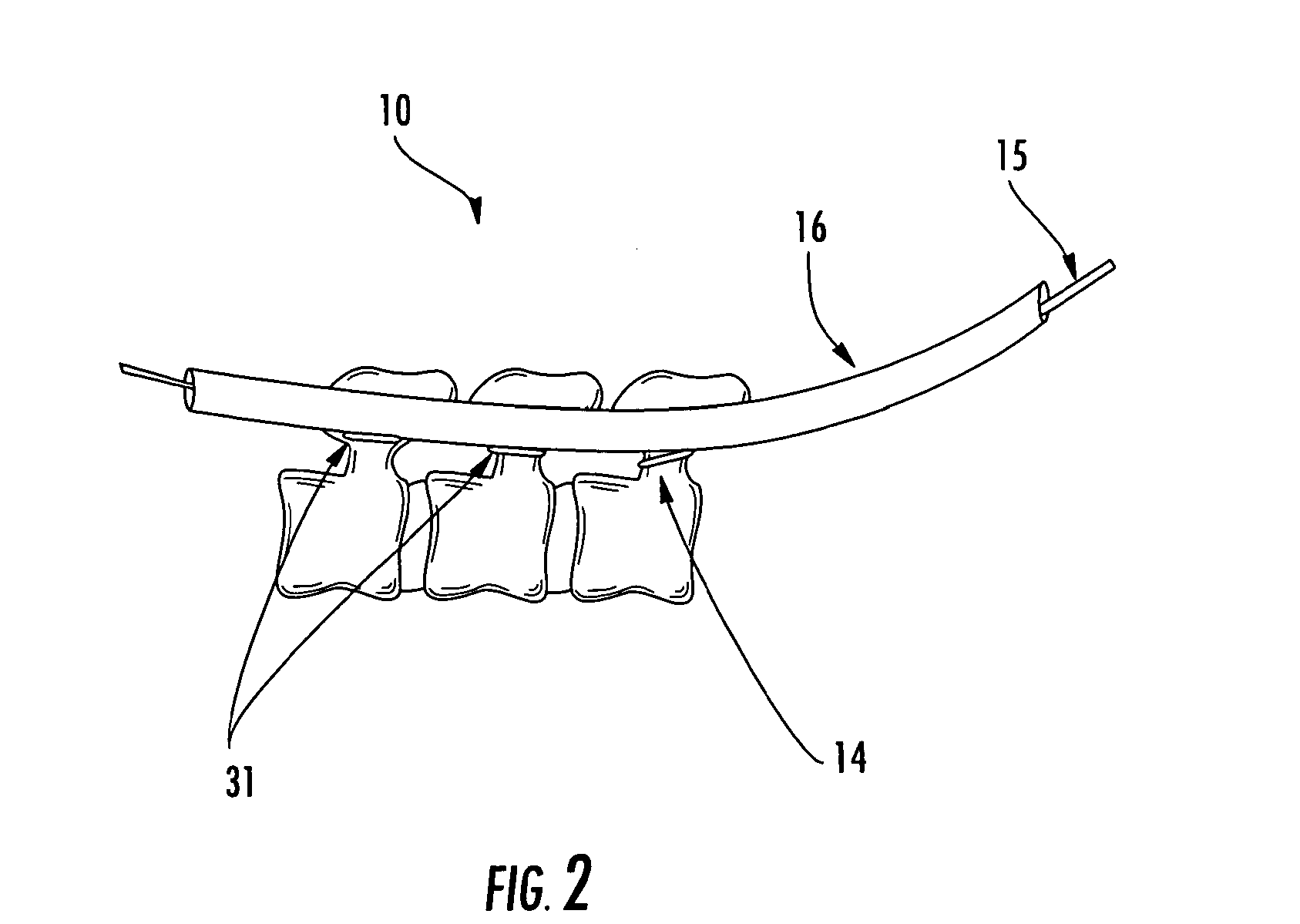 Percutaneous posterolateral spine fusion