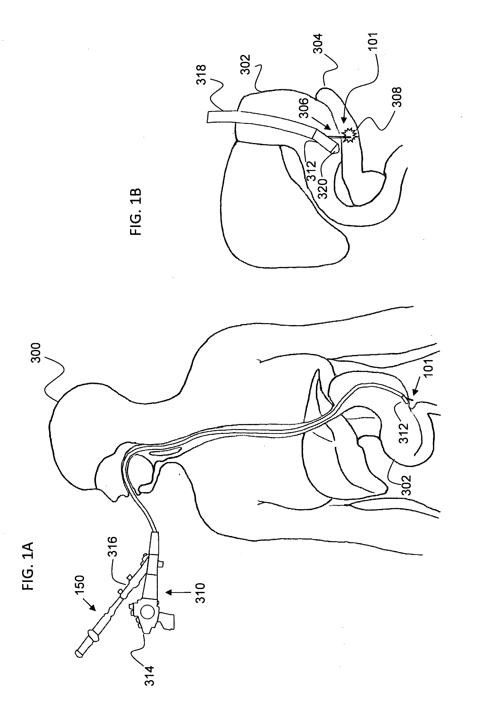 Method and system for implant delivery