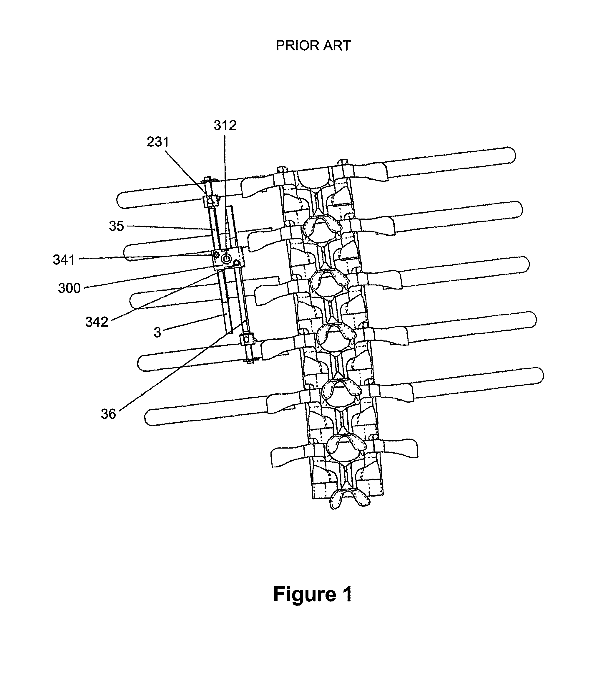 Distraction and damping system which can be adjusted as the vertebral column grows