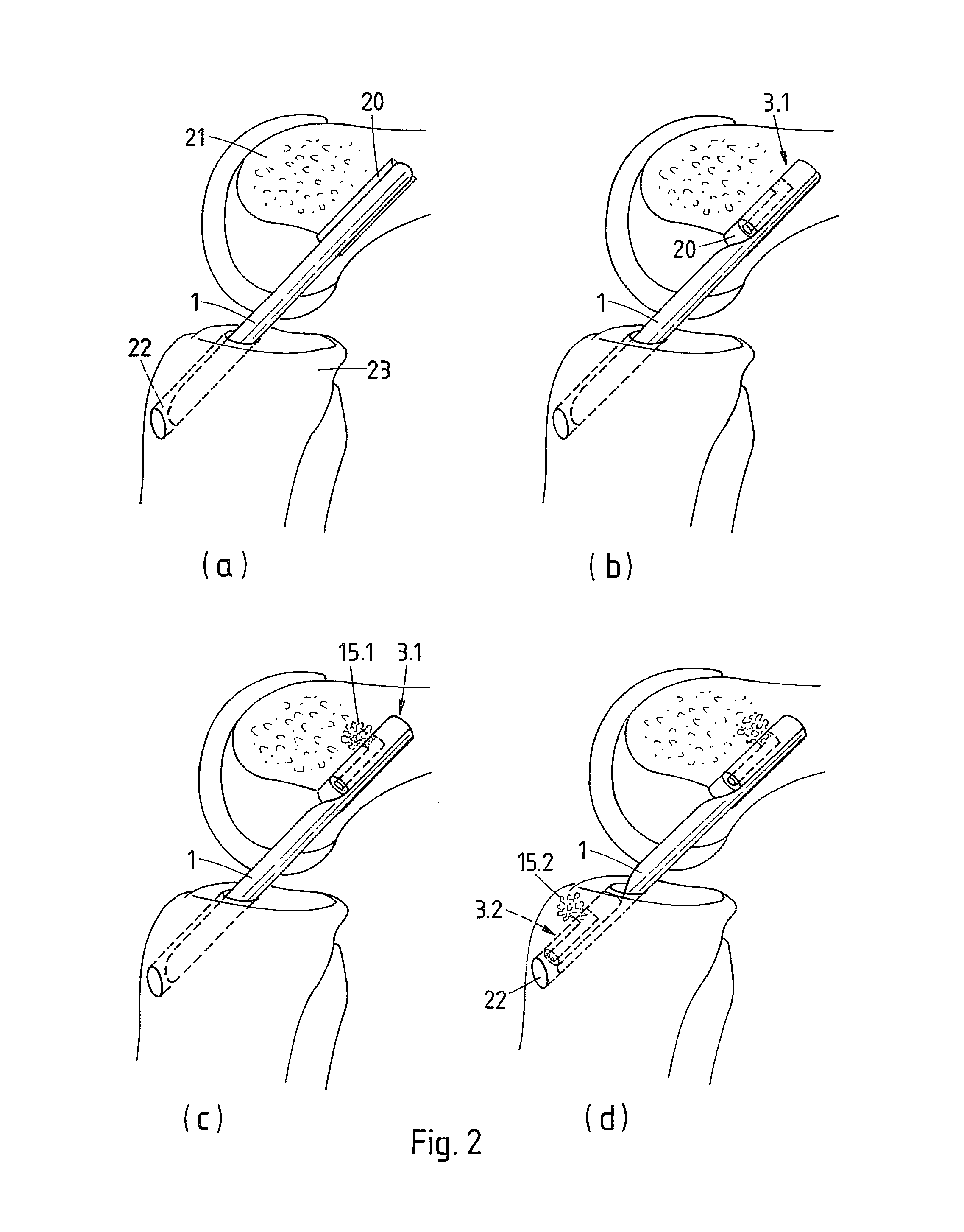 Method of fastening a tissue or a corresponding prosthetic element in an opening provided in a human or animal bone and fastener suitable for the method