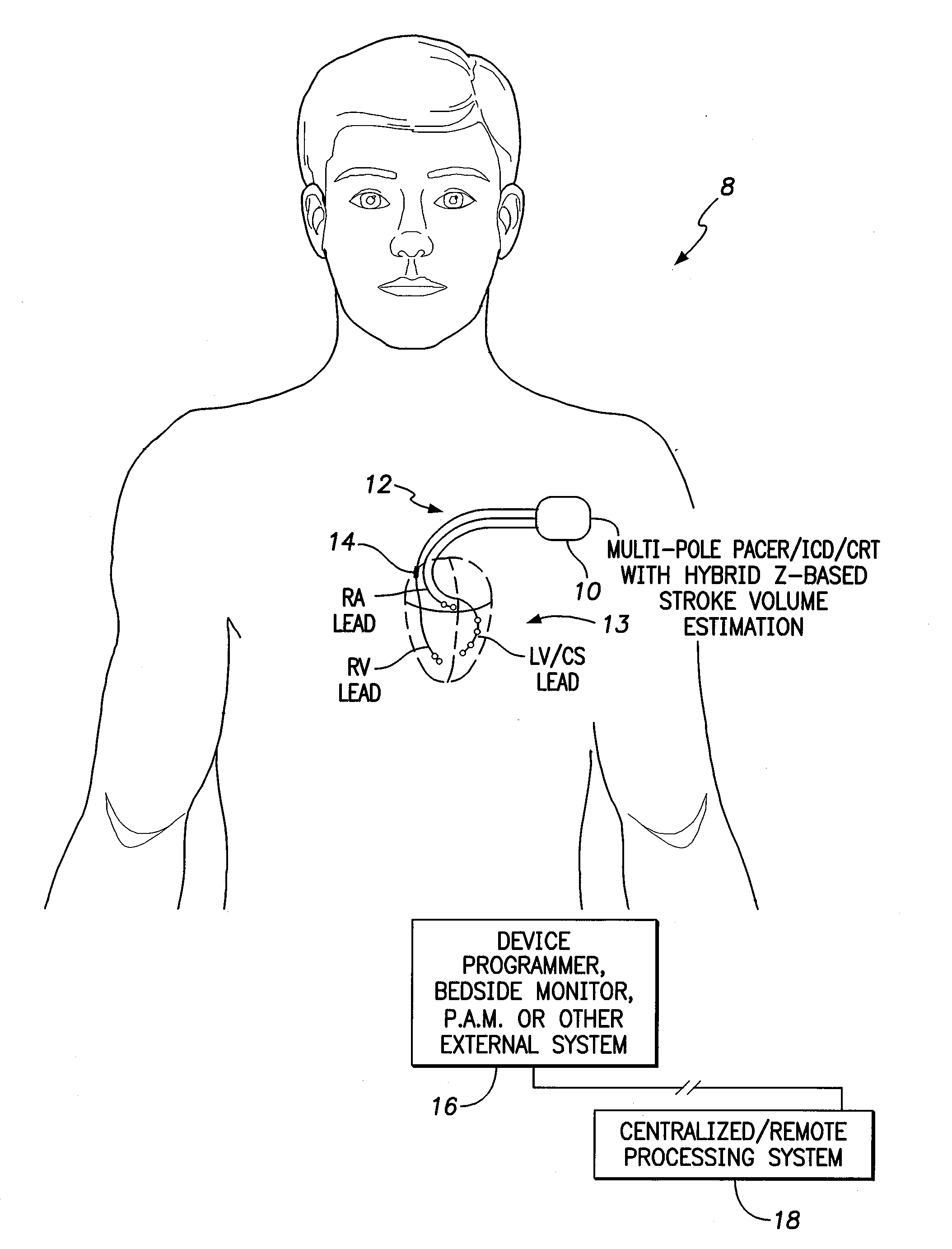 Systems and methods for tracking stroke volume using hybrid impedance configurations employing a multi-pole implantable cardiac lead