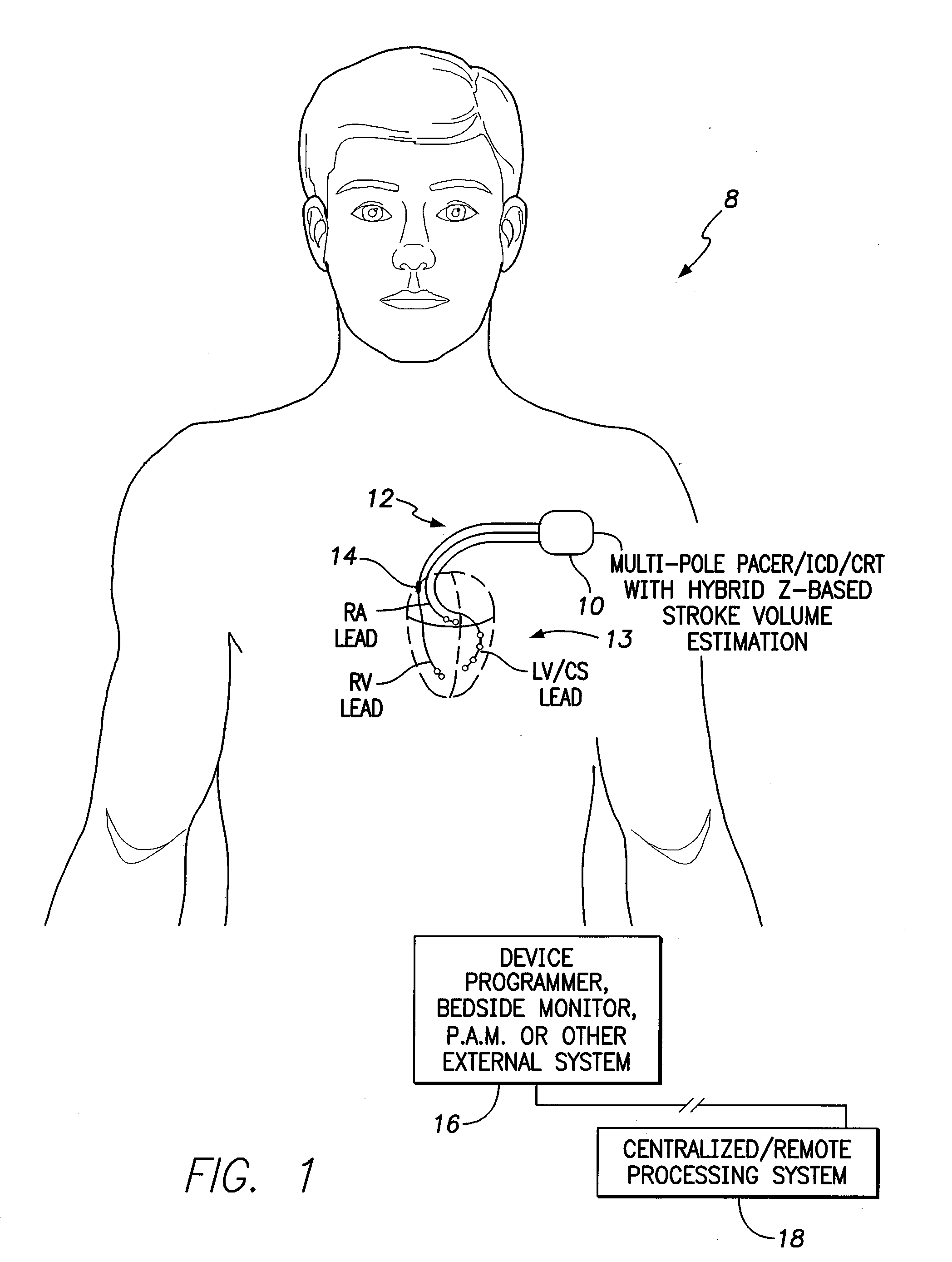 Systems and methods for tracking stroke volume using hybrid impedance configurations employing a multi-pole implantable cardiac lead