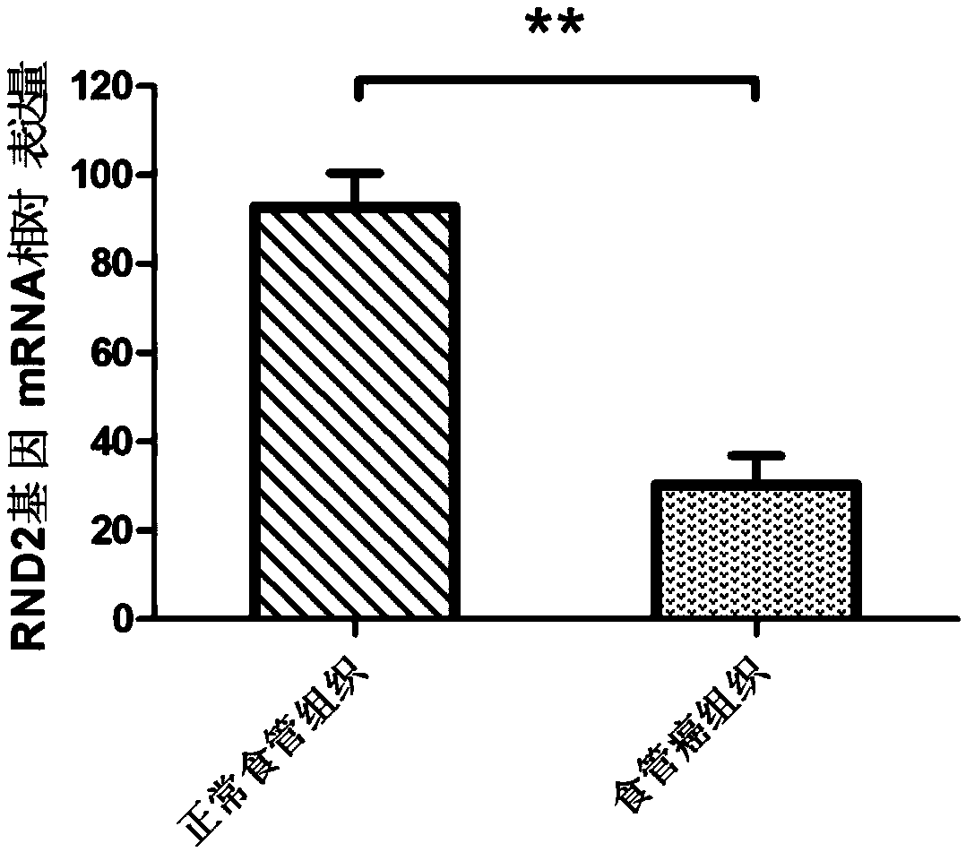 Preparation for detection, diagnosis or prognostic evaluation of esophageal cancer, medicament for treating esophageal cancer and application of RND2 gene