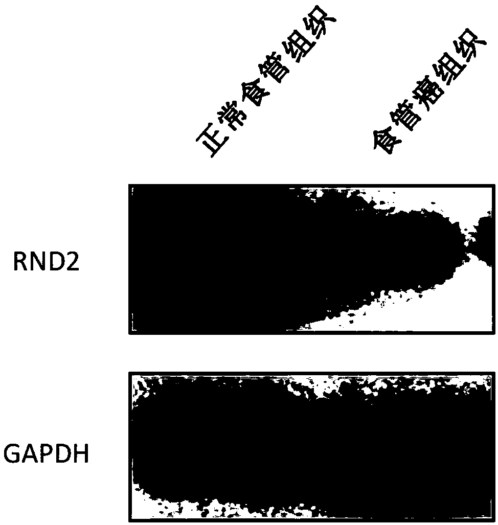 Preparation for detection, diagnosis or prognostic evaluation of esophageal cancer, medicament for treating esophageal cancer and application of RND2 gene