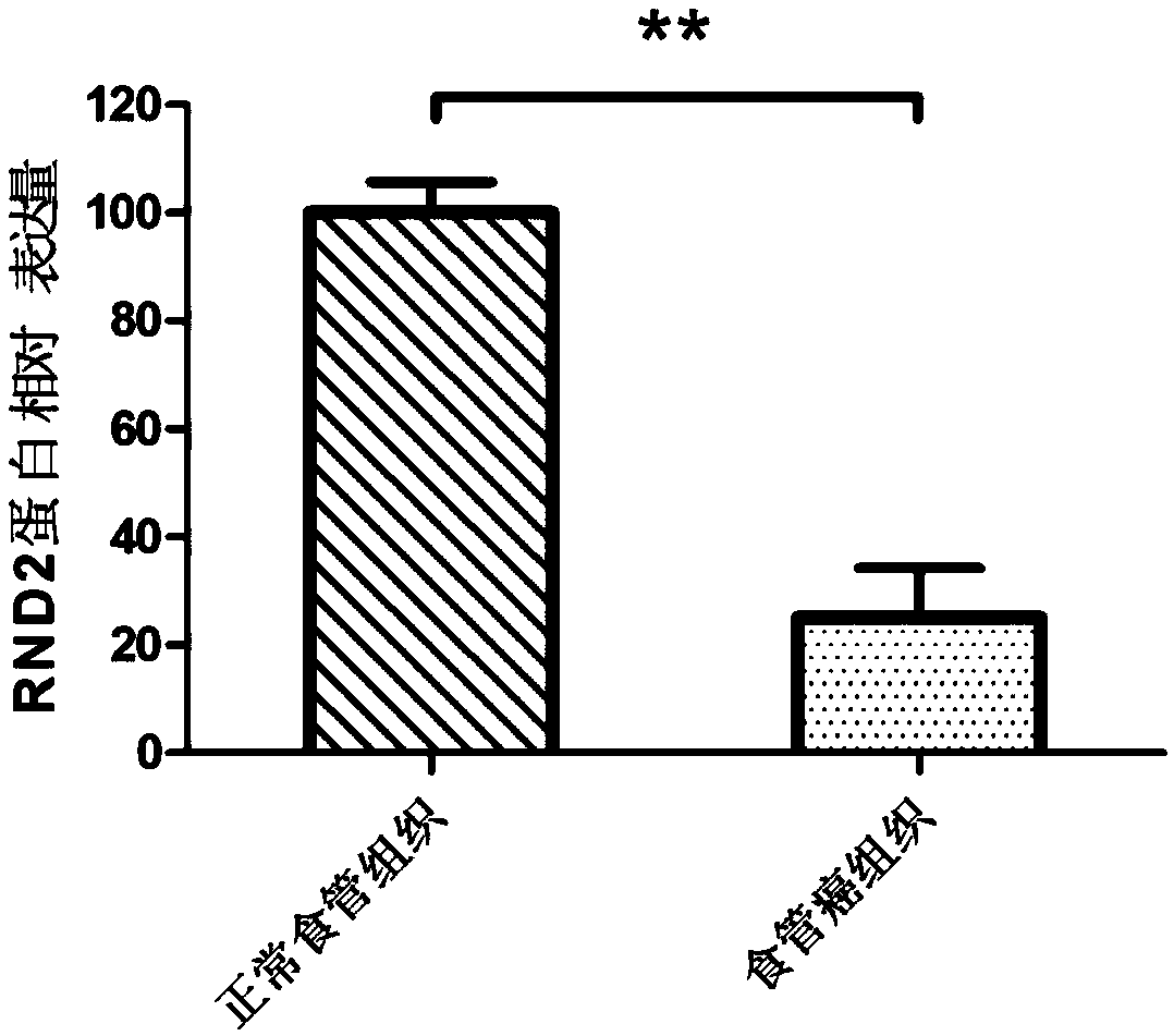 Preparation for detection, diagnosis or prognostic evaluation of esophageal cancer, medicament for treating esophageal cancer and application of RND2 gene