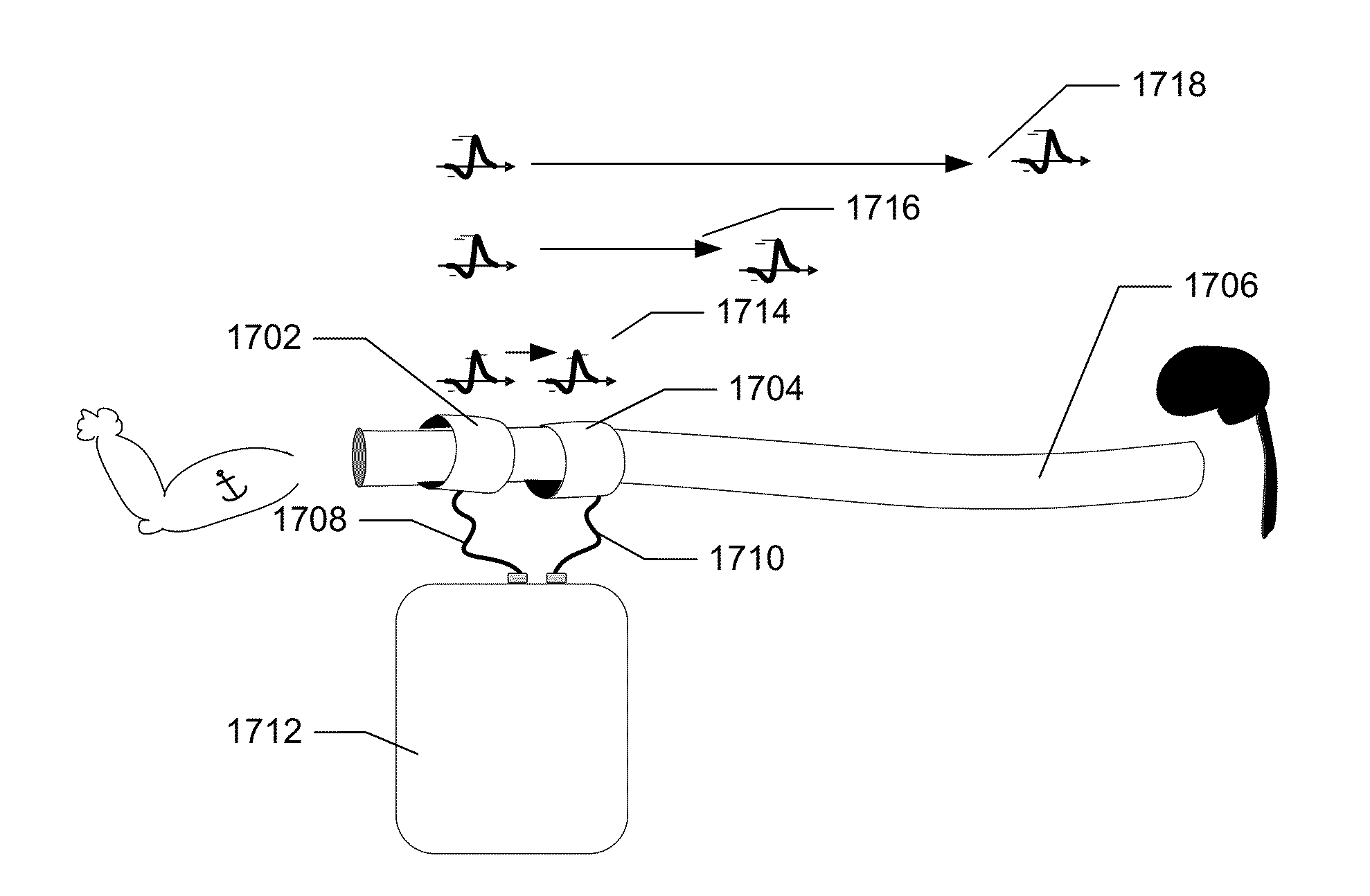 Neural monitoring methods and systems for treating upper airway disorders