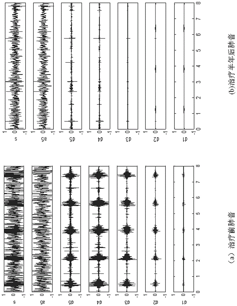 A digital detection and analysis device for pulmonary interstitial fibrosis based on lung sounds